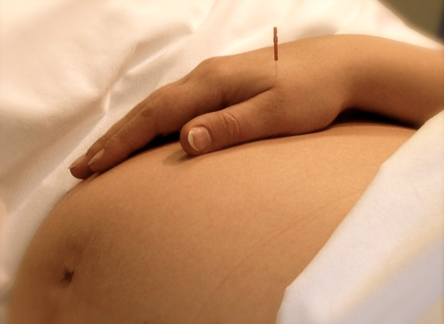 Pregnant Lady having acupuncture